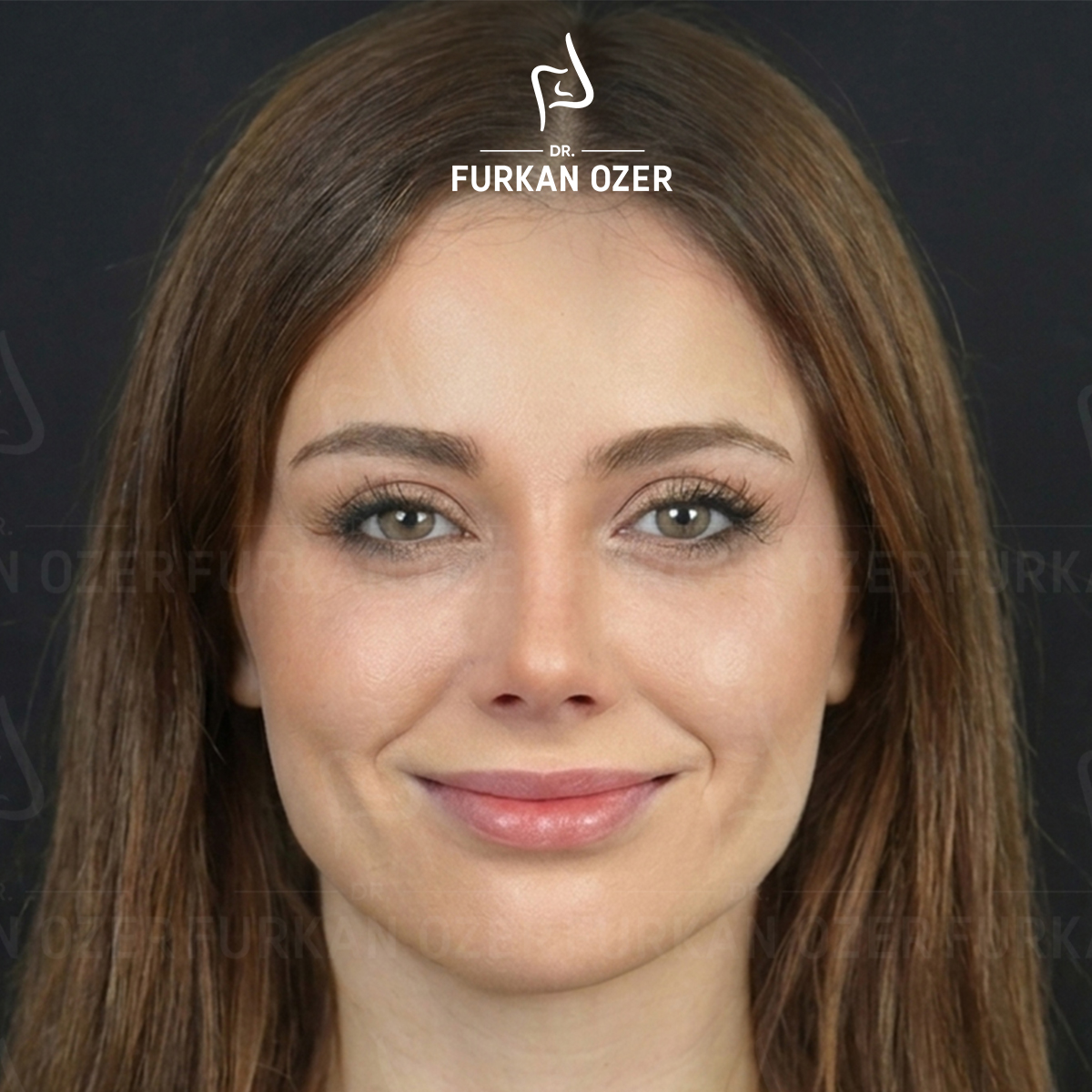 Estetik cerrahi sonrası sonuç - Dr. Furkan Özer