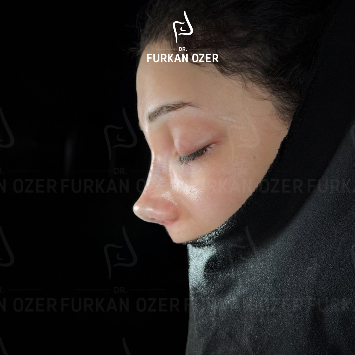 Estetik cerrahi sonrası sonuç - Dr. Furkan Özer