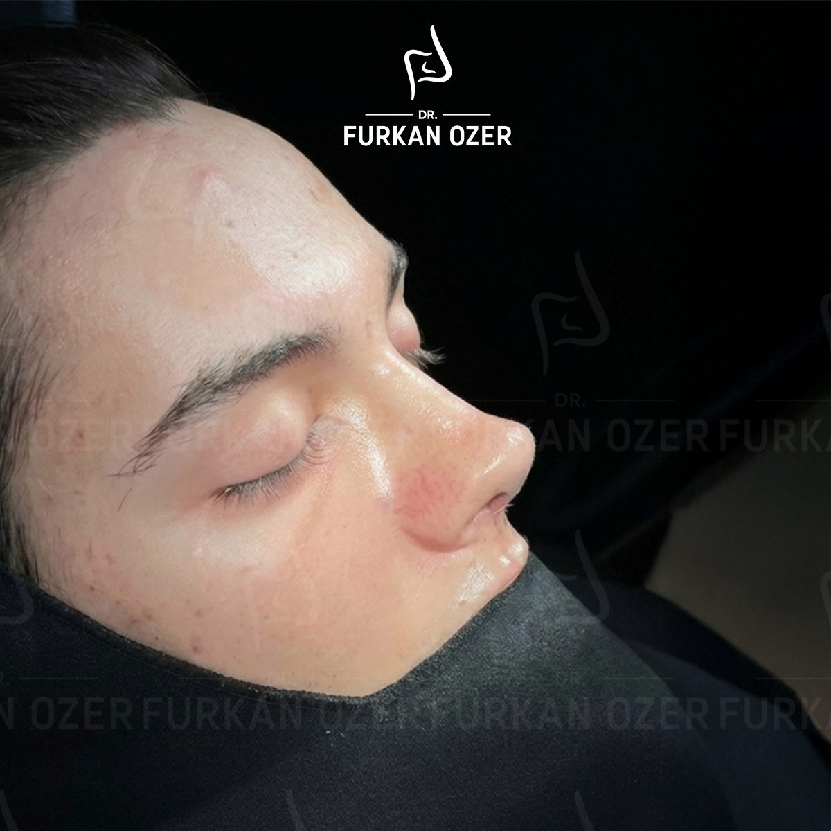 Estetik cerrahi sonrası sonuç - Dr. Furkan Özer