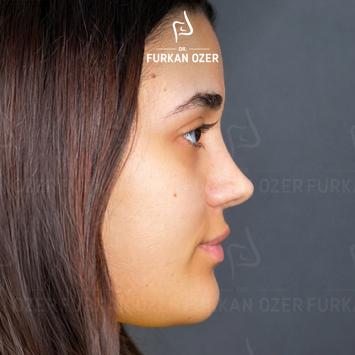 Estetik cerrahi sonrası sonuç - Dr. Furkan Özer