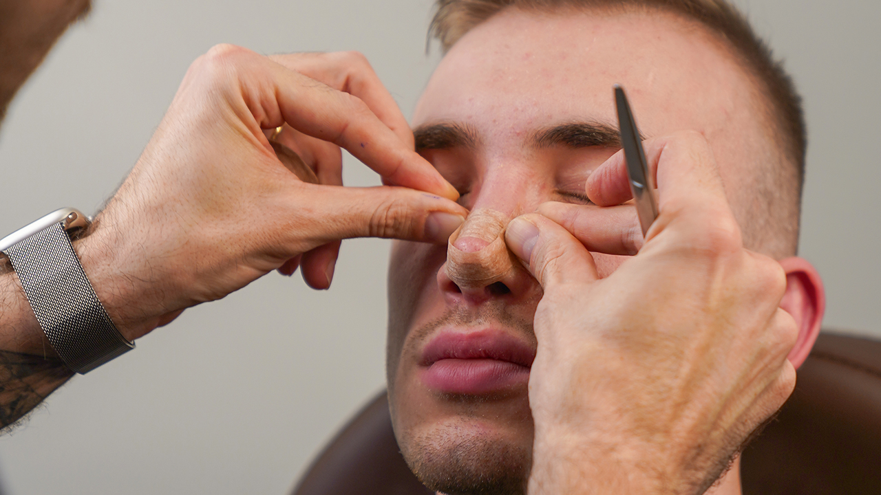 Revision Rhinoplasty (Revizyon Burun Estetiği)